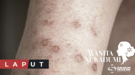 Ilustrasi kulit yang mengidap HIV. l Istimewa