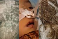 Tubuh Raya, bocah Sukabumi dipenuhi cacing - Rumah Teduh