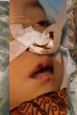 KDM sanksi Pemdes dan bidan, bocah di Kabandungan Sukabumi meninggal sebab cacingan akut