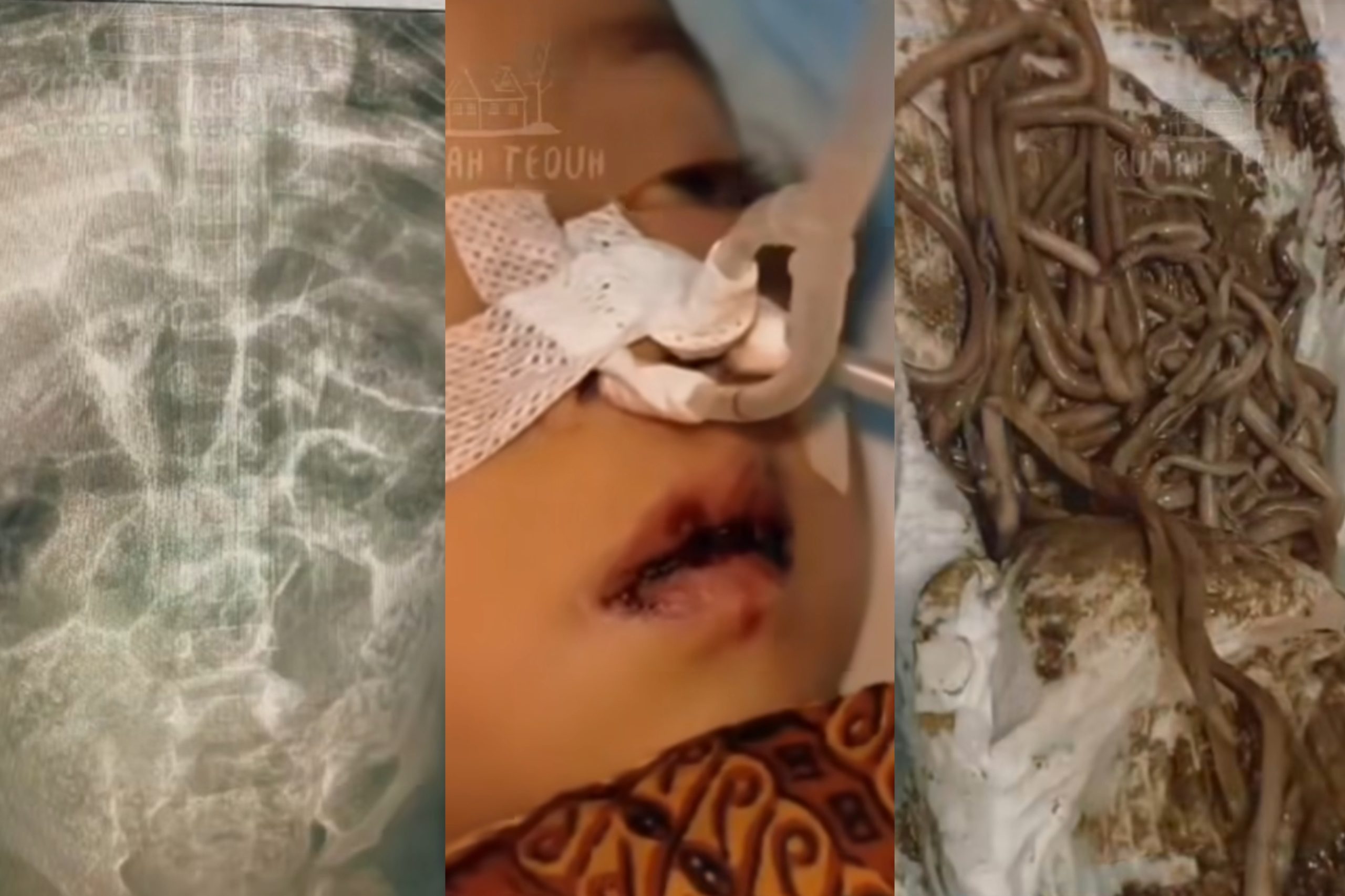 Tubuh Raya dipenuhi cacing