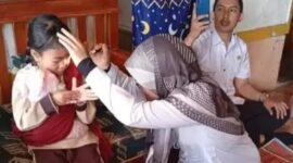 Nasib pilu Syakira, bocah di Sukabumi alami kelainan mata tak berkedip sejak lahir - Ist