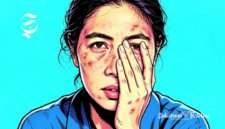 Ilustrasi perempuan menderita penyakit kulit di bagian wajah - sukabumiheadline.com
