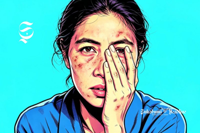 Ilustrasi perempuan menderita penyakit kulit di bagian wajah - sukabumiheadline.com